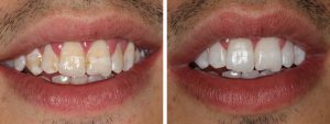 Teeth Whitening Case Study 02 A