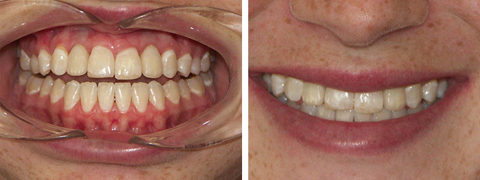 After Dental Implant Insertion