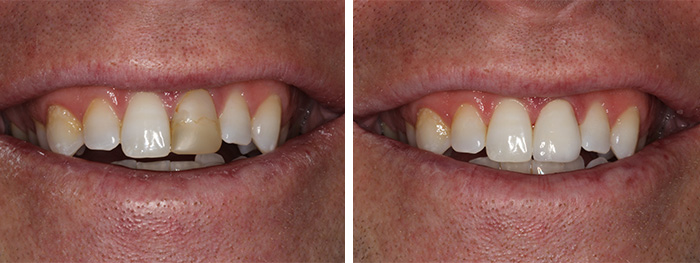 Before & After Single Dental Crown