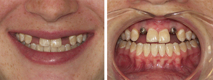 Before & During Dental Implant Insertion