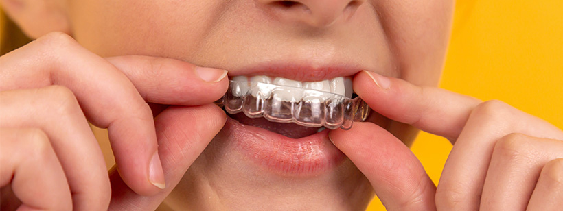 How to take care of your clear aligners (Invisible braces)